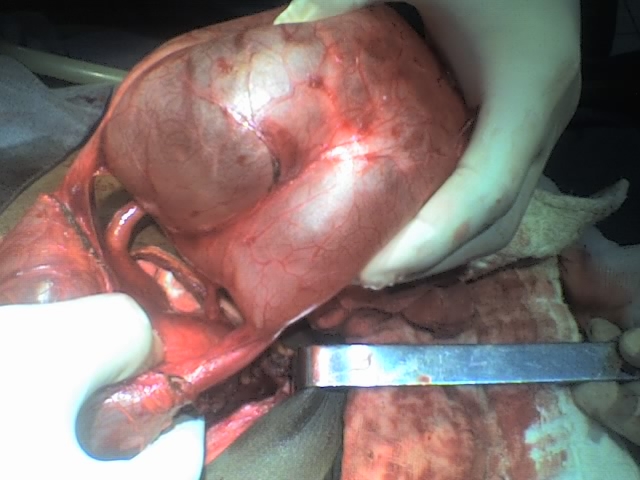 ureteral quadruplication with proximal cystic dilatation